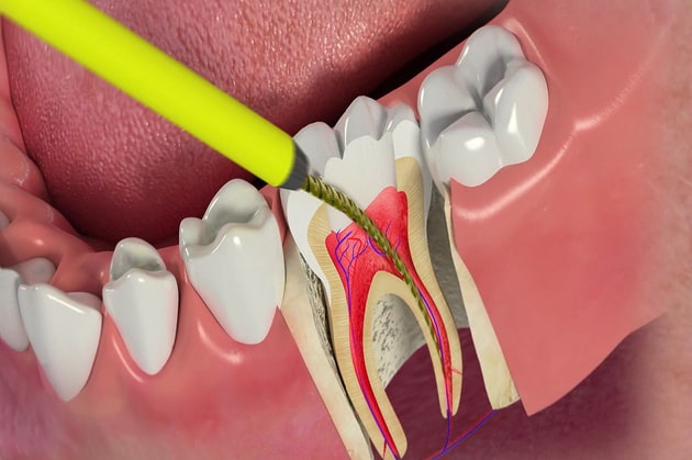 Причины болей после депульпирования зуба