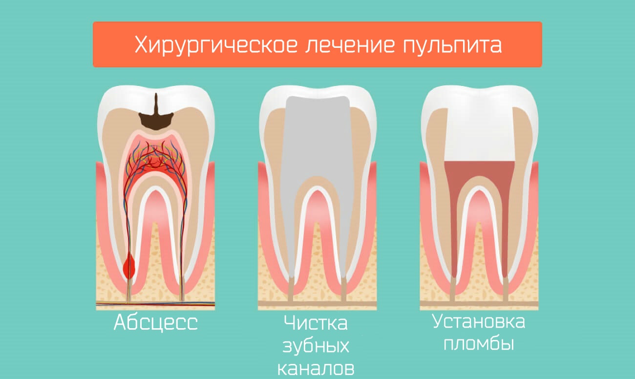 Хирургический метод лечения пульпита