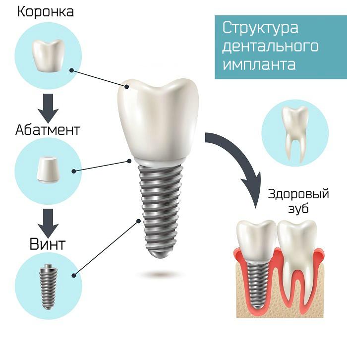 Имплантация системы AlphaBio