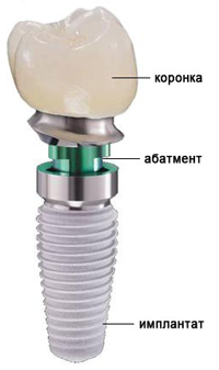 Имплантаты зубов