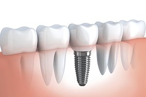 Имплантаты зубов, установка имплантатов зубов