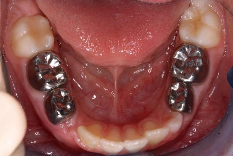 Металлические зубные коронки 