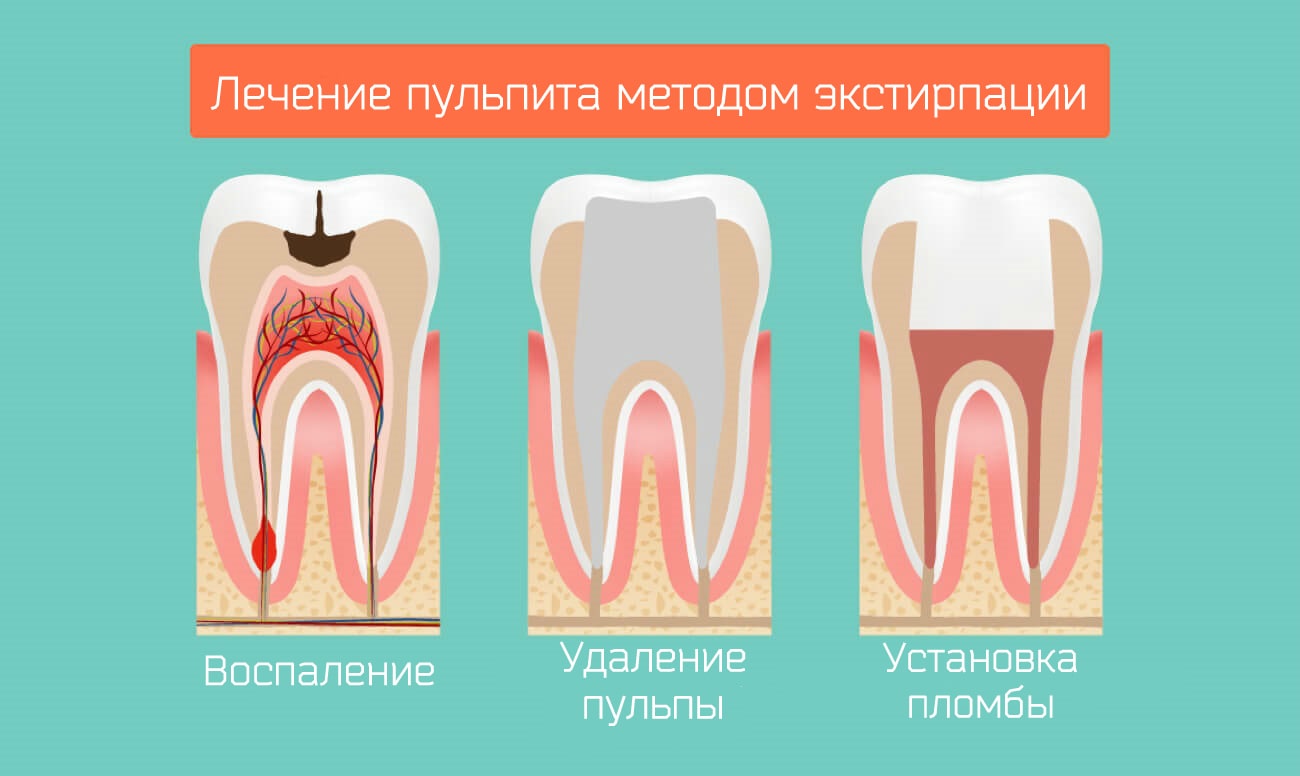 Лечение пульпита методом экстирпации