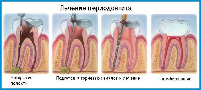 periodontit u detei