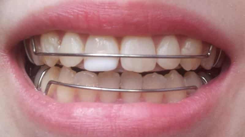 Пластины для зубов