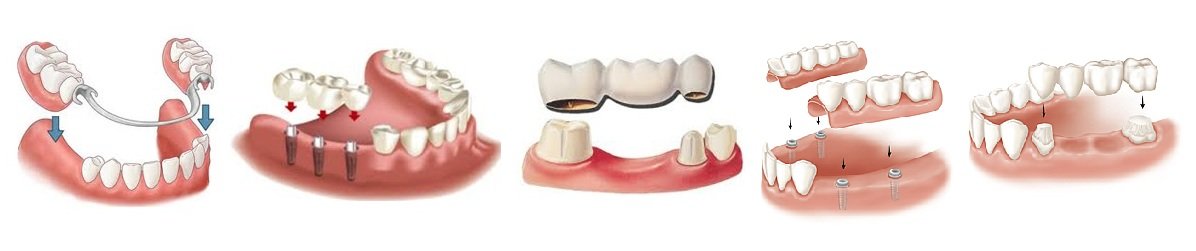Протезирование зубов при отсутствии зубов