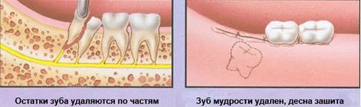 Удаление зуба мудрости