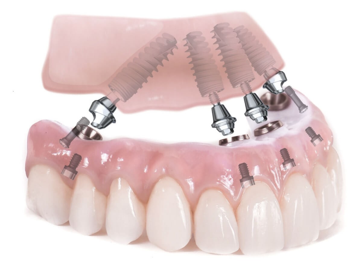 Условно-съемные зубные протезы