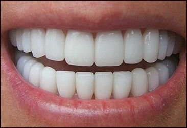 Зубы металлокерамика