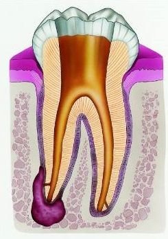 Лечение кисты зуба