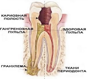 Периодонтит лечение