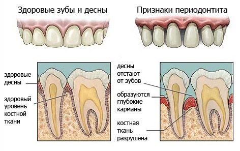 Периодонтит лечение